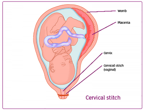 Weak cervix cervical incompetence or cervical insufficiency